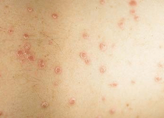 Etapa inicial de la psoriasis.