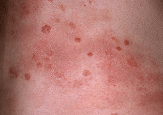 etapa progresiva de la psoriasis