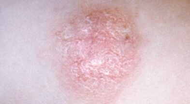 Cómo detectar la psoriasis a tiempo