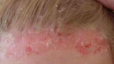 Etapas de desarrollo y síntomas de la psoriasis.