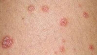 Foto de psoriasis en las primeras etapas.