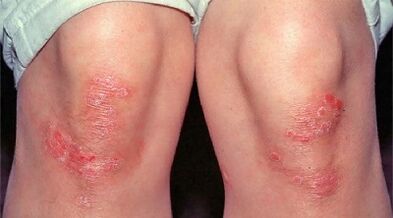 Principales manifestaciones de la psoriasis
