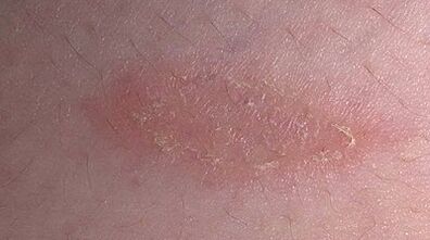 cómo y con qué tratar la psoriasis