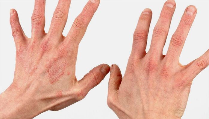 Métodos para tratar la psoriasis con remedios caseros.