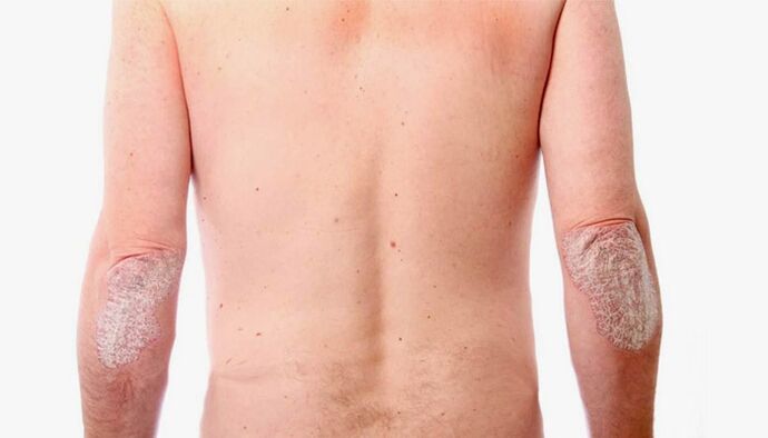 Remedios populares para el tratamiento de la psoriasis.