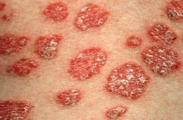 Pápulas de psoriasis
