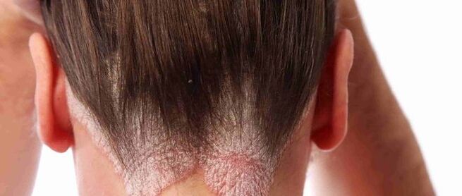 Psoriasis de la cabeza