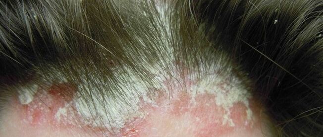 Psoriasis en la cabeza