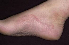 Psoriasis del pie