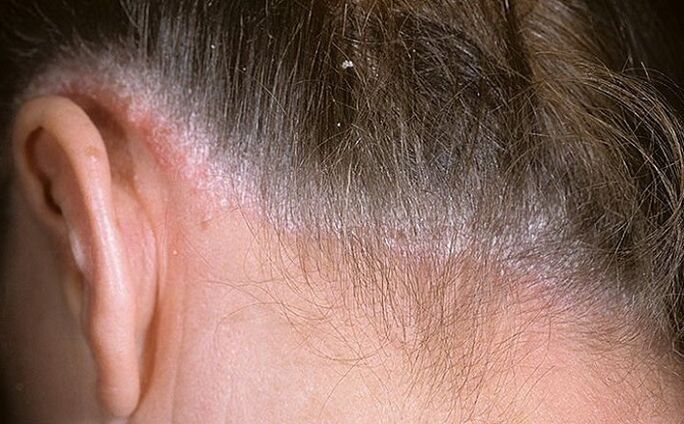 Psoriasis en el cabello