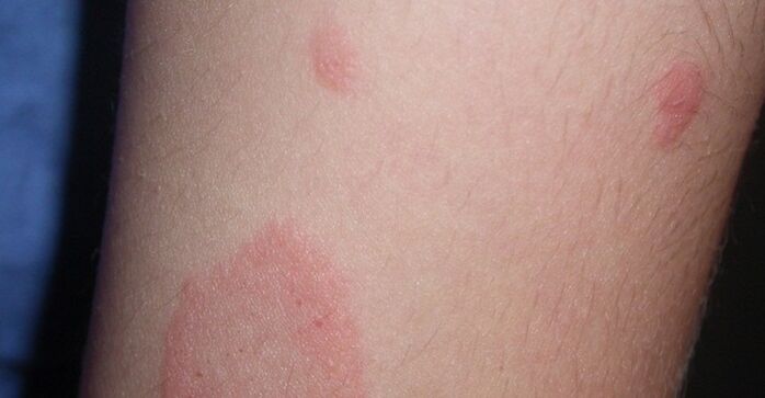 soriasis