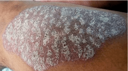 Patogénesis de la psoriasis