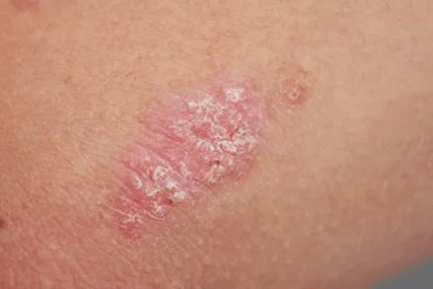 Psoriasis - Etapa inicial