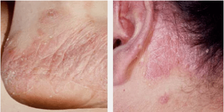 Tipos de psoriasis