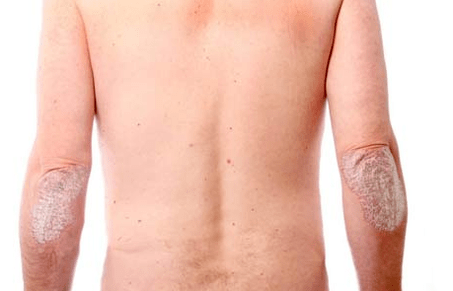 Síntomas generales de la psoriasis