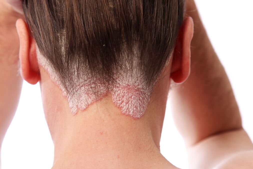 Tratamiento de la psoriasis