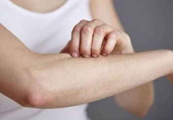 Psoriasis en la mano