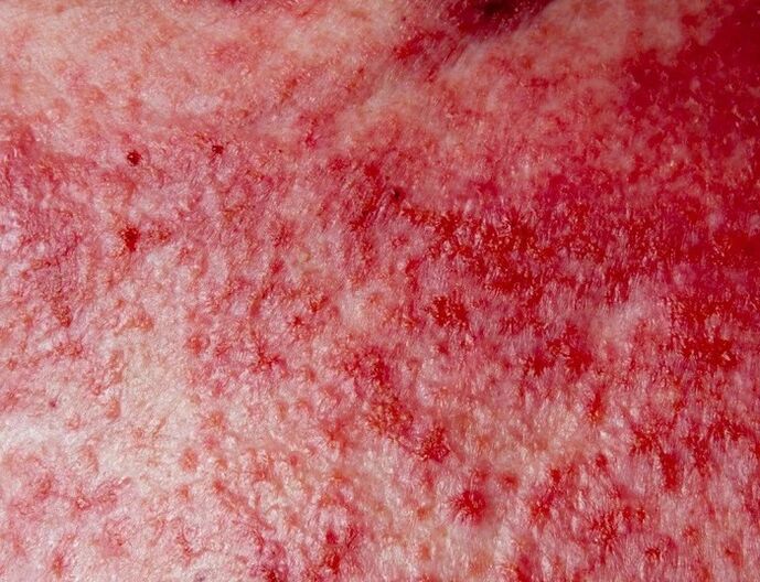 Forma avanzada de psoriasis