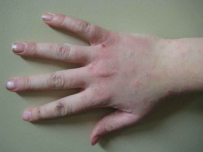 Psoriasis en etapa temprana