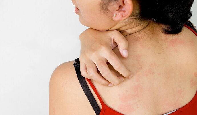 Psoriasis en la espalda