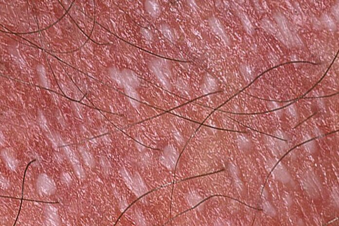 psoriasis pustulosa