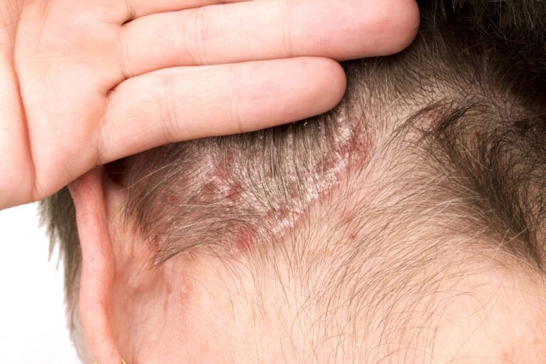 Empeoramiento de la psoriasis en la cabeza.
