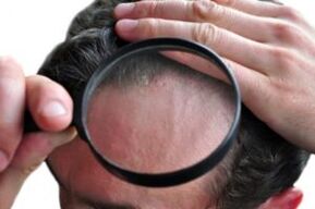 Psoriasis en la cabeza a través de una lupa.