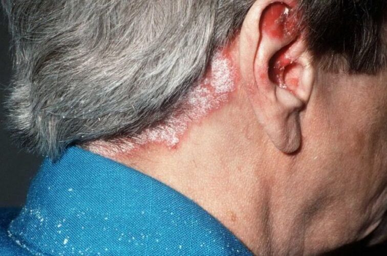 Psoriasis en la cabeza