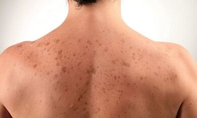 Razones para el desarrollo de la psoriasis.
