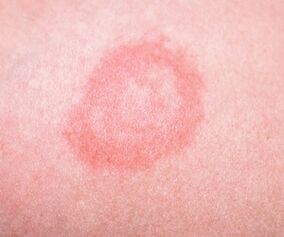 Etapa inicial de la psoriasis.