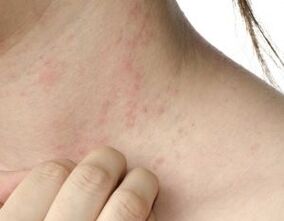 Principales síntomas de la psoriasis