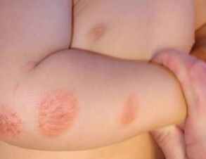 Síntomas de psoriasis en niños.