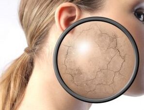 ¿Cómo se manifiesta la psoriasis