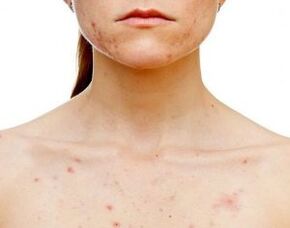 ¿En qué parte del cuerpo se produce la psoriasis