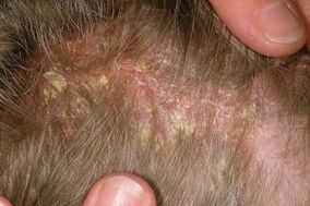 Psoriasis en la cabeza