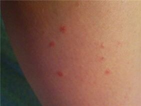 Psoriasis en la piel