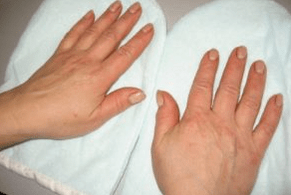 Psoriasis de las uñas